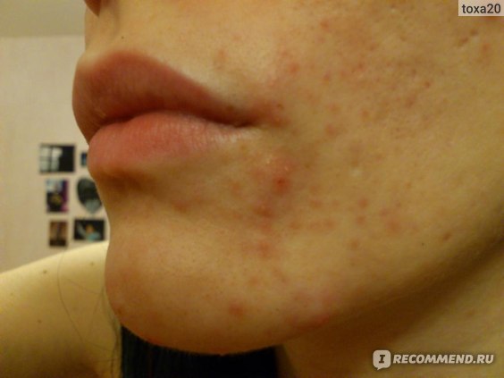 BALHHAM LA ROCHE POSAY CICAPLAST BAUME B5 - «PROTOSTO -SPAAS OT ...
