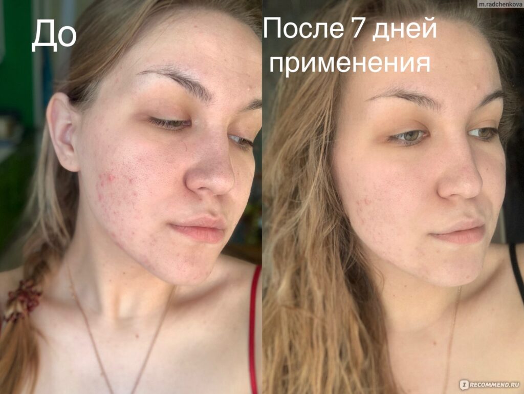 Krem -gely dliцaa la roche posay effaclar duo - «spehцialanganododod ...